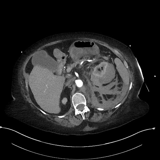 Active renal extravasation with large subcapsular and retroperitoneal hemorrhage (Radiopaedia 60975-68796 Axial C+ arterial phase 66).jpg