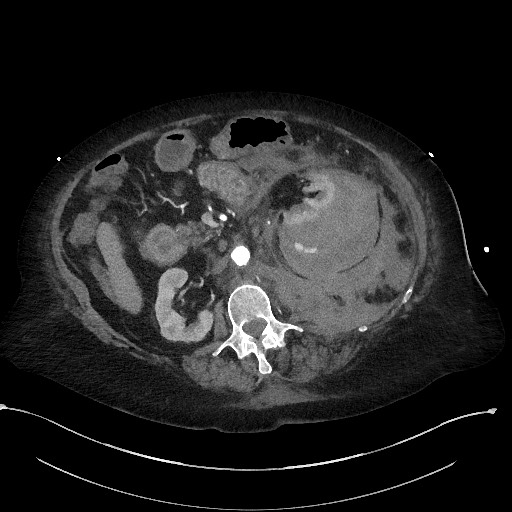 Active renal extravasation with large subcapsular and retroperitoneal hemorrhage (Radiopaedia 60975-68796 Axial C+ arterial phase 82).jpg