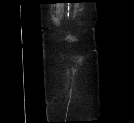Active renal extravasation with large subcapsular and retroperitoneal hemorrhage (Radiopaedia 60975-68796 Coronal C+ arterial phase 144).jpg