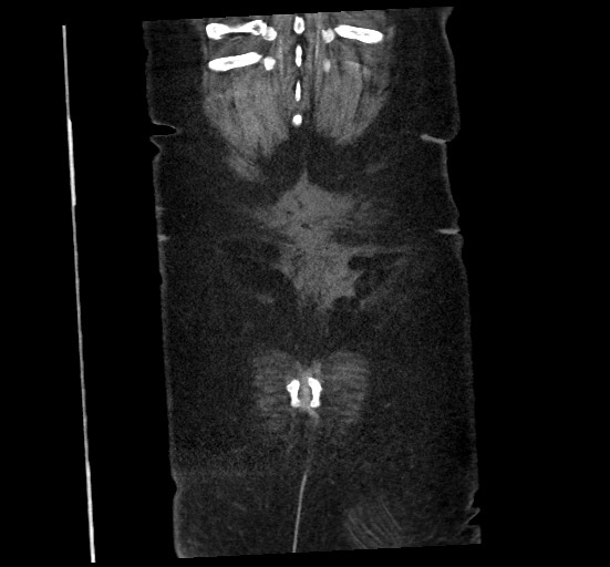 Active renal extravasation with large subcapsular and retroperitoneal hemorrhage (Radiopaedia 60975-68796 Coronal C+ portal venous phase 141).jpg