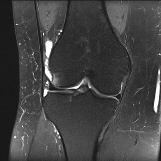 File:Acute-on-chronic transient lateral patellar dislocation with trochlear dysplasia (Radiopaedia 84099-99349 Coronal PD fat sat 21).jpg