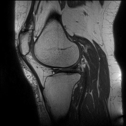 Acute-on-chronic transient lateral patellar dislocation with trochlear dysplasia (Radiopaedia 84099-99349 Sagittal PD 107).jpg