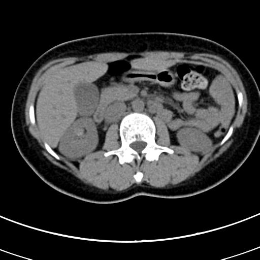 Acute appendicitis (Radiopaedia 30261-30888 Axial non-contrast 27).jpg