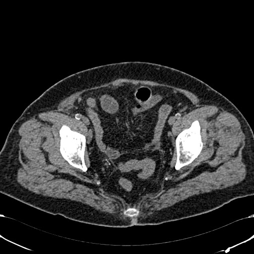 Acute appendicitis (Radiopaedia 58627-65818 Axial non-contrast 78).jpg
