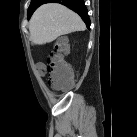 Acute appendicitis (Radiopaedia 66513-75790 Sagittal C+ portal venous phase 23).jpg