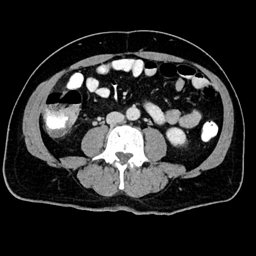 Acute appendicitis (Radiopaedia 77016-88960 Axial C+ portal venous phase 80).jpg