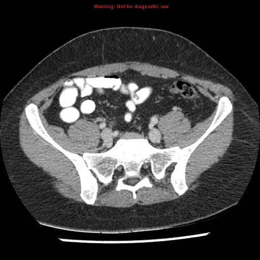 Acute appendicitis (Radiopaedia 7966-8812 C+ portal venous phase 38).jpg