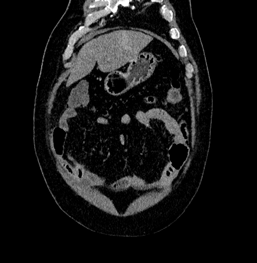 File:Acute appendicitis (Radiopaedia 79950-93224 Coronal C+ portal venous phase 14).jpg