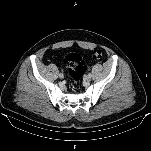 Acute appendicitis (Radiopaedia 84780-100240 Axial C+ portal venous phase 88).jpg