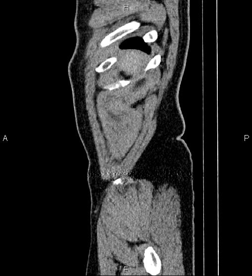 File:Acute appendicitis (Radiopaedia 84780-100240 Sagittal C+ portal venous phase 3).jpg