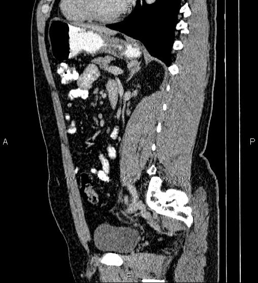 File:Acute appendicitis (Radiopaedia 84780-100240 Sagittal C+ portal venous phase 65).jpg
