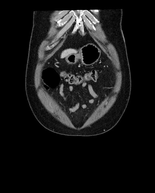 Acute appendicitis - large appendicoliths (Radiopaedia 61805-69820 Coronal C+ portal venous phase 22).jpg