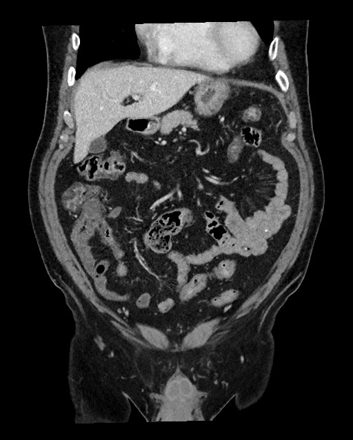 Acute appendicitis - large appendicoliths (Radiopaedia 61805-69820 Coronal C+ portal venous phase 43).jpg