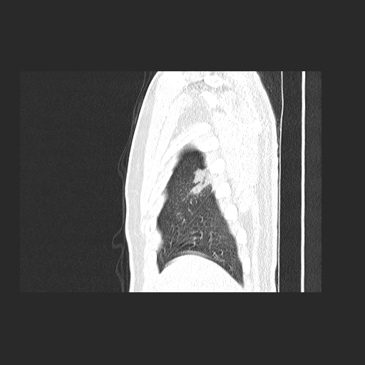 Acute appendicitis and COVID 19 pneumonia (Radiopaedia 76604-88380 Sagittal lung window 14).jpg