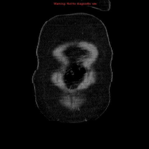 Acute appendicitis complicated by ovarian vein thrombophlebitis (Radiopaedia 16172-15851 Coronal C+ portal venous phase 9).jpg