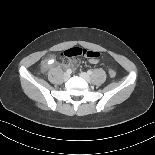 Acute appendicitis with appendicoliths (Radiopaedia 50186-55532 Axial C+ portal venous phase 57).png