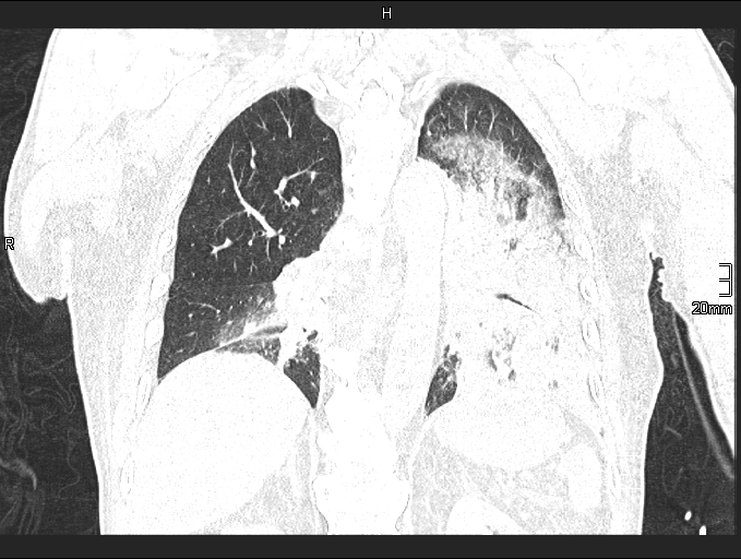 File:Acute aspiration pneumonitis (Radiopaedia 55642-62166 Coronal lung window 68).jpg