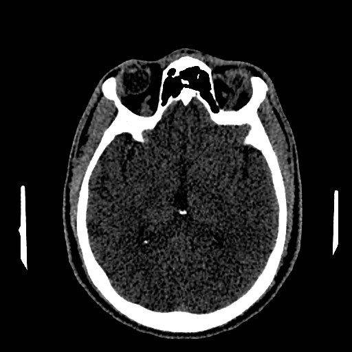 Acute basilar artery occlusion (Radiopaedia 43582-46985 Axial non-contrast 91).jpg