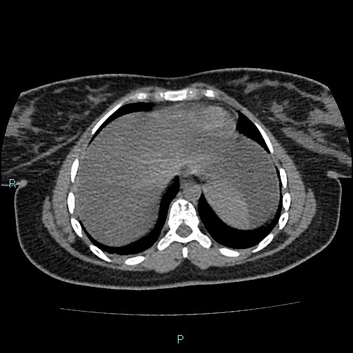 Acute bilateral pyelonephritis (Radiopaedia 37146-38881 Axial non-contrast 8).jpg