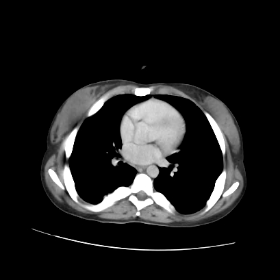File:Acute calculous cholecystitis in patient with osteopetrosis (Radiopaedia 77871-90159 Axial C+ portal venous phase 6).jpg