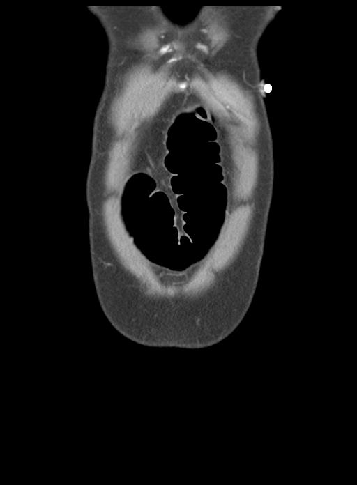 Acute cholecystitis (Radiopaedia 29814-30327 Coronal C+ portal venous phase 6).jpg