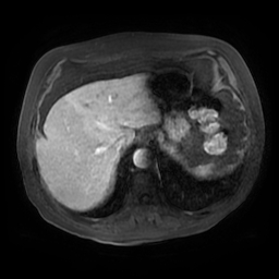Acute cholecystitis complicated by pylephlebitis (Radiopaedia 65782-74915 Axial arterioportal phase T1 C+ fat sat 21).jpg