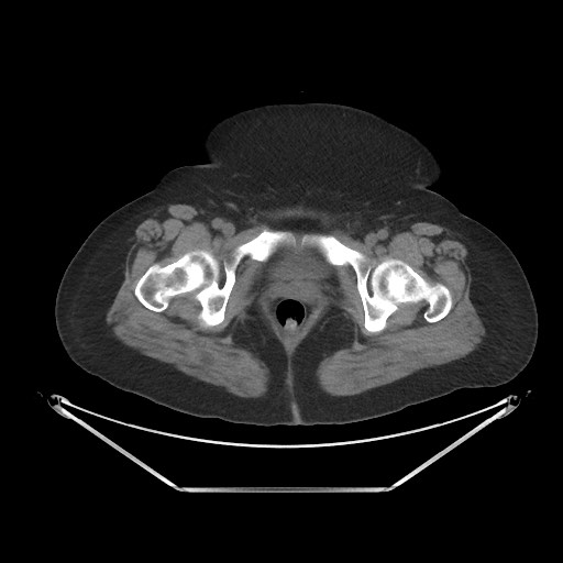 Acute cholecystitis with tensile fundus sign (Radiopaedia 71394-81723 Axial non-contrast 117).jpg