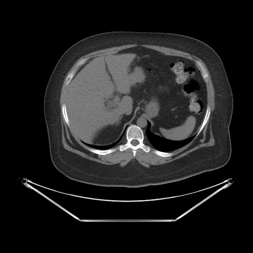 File:Acute cholecystitis with tensile fundus sign (Radiopaedia 71394-81723 Axial non-contrast 8).jpg