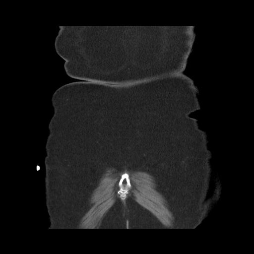 Acute cholecystitis with tensile fundus sign (Radiopaedia 71394-81723 Coronal non-contrast 118).jpg