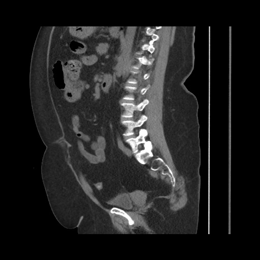 File:Acute cholecystitis with tensile fundus sign (Radiopaedia 71394-81723 Sagittal non-contrast 98).jpg