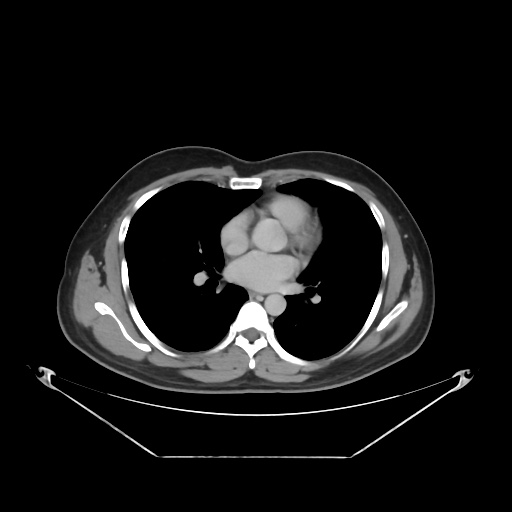 File:Acute complicated calculous cholecystitis (Radiopaedia 55202-61587 Axial C+ delayed 7).jpg