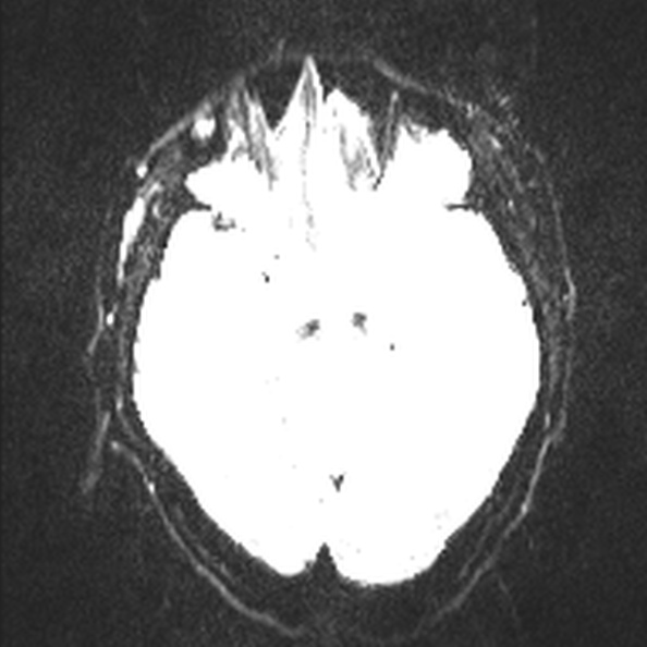Acute disseminated encephalomyelitis (Radiopaedia 37253-39033 Axial DWI 12).jpg
