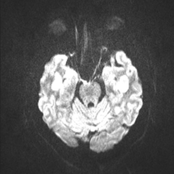 Acute disseminated encephalomyelitis (Radiopaedia 37253-39033 Axial DWI 37).jpg