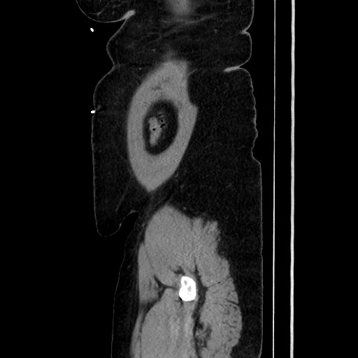 Acute diverticulitis - transverse colon (Radiopaedia 87063-103327 Sagittal C+ portal venous phase 196).jpg