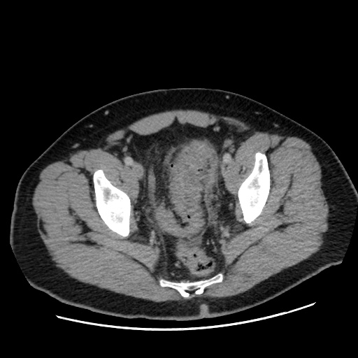 Acute diverticulitis with localized perforation (Radiopaedia 41296-44113 Axial C+ portal venous phase 80).jpg