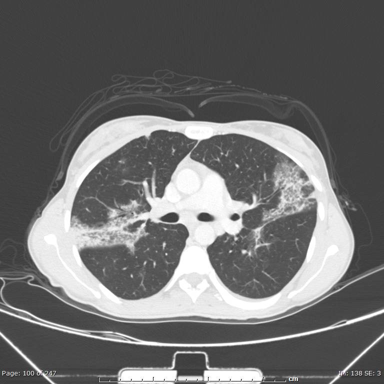 Acute eosinophilic pneumonia (Radiopaedia 48211-53073 Axial lung window 36).jpg