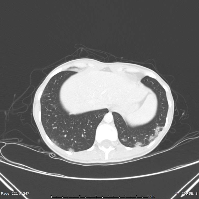 Acute eosinophilic pneumonia (Radiopaedia 48211-53073 Axial lung window 79).jpg