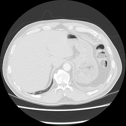 Acute epicardial fat necrosis (Radiopaedia 42327-45440 Axial lung window 50).jpg