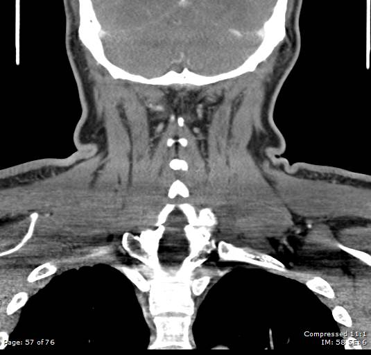 File:Acute epiglottitis (Radiopaedia 54375-60590 Coronal C+ arterial phase 57).jpg