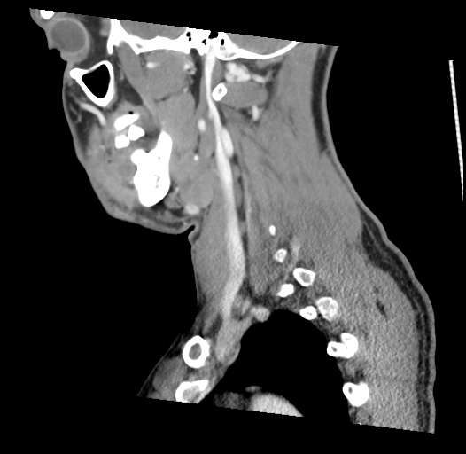 Acute longus colli calcific tendinitis (Radiopaedia 72495-83036 Sagittal C+ arterial phase 16).jpg