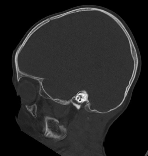 Acute mastoiditis (Radiopaedia 82678-96881 Sagittal bone window 47).jpg