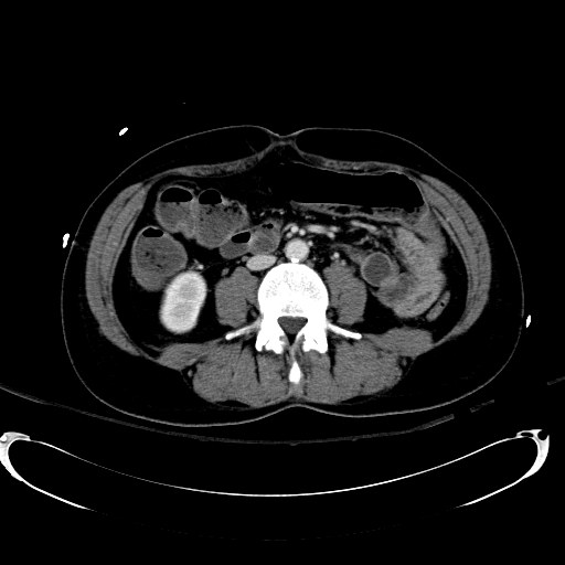File:Acute myocardial infarction in CT (Radiopaedia 39947-42415 Axial C+ portal venous phase 71).jpg