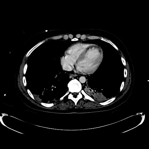 File:Acute myocardial infarction in CT (Radiopaedia 39947-42457 Axial C+ portal venous phase 5).jpg