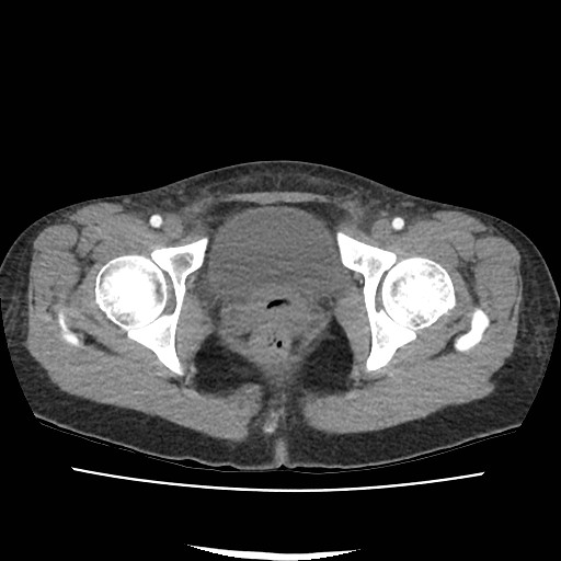 File:Acute myocarditis (Radiopaedia 55988-62613 Axial C+ portal venous phase 78).jpg