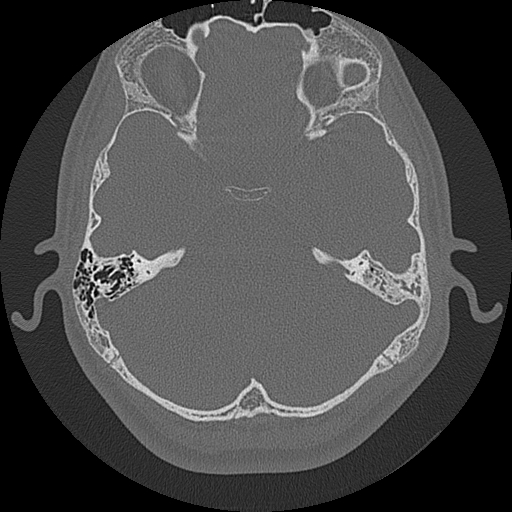 Acute otomastoiditis and Bezold abscess (Radiopaedia 88184-104786 Axial bone window 44).jpg