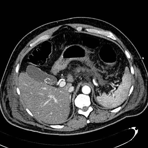 File:Acute pancreatic necrosis (Radiopaedia 13560-13486 Axial C+ portal venous phase 40).jpg