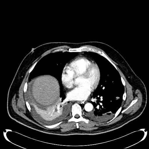 Acute pancreatic necrosis (Radiopaedia 13560-18500 Axial C+ portal venous phase 7).jpg
