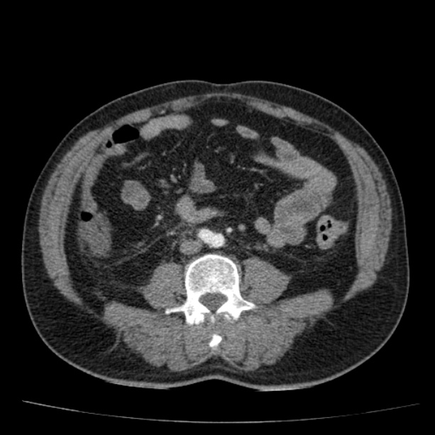 Acute pancreatitis (Radiopaedia 26663-26813 Axial C+ arterial phase 61).jpg