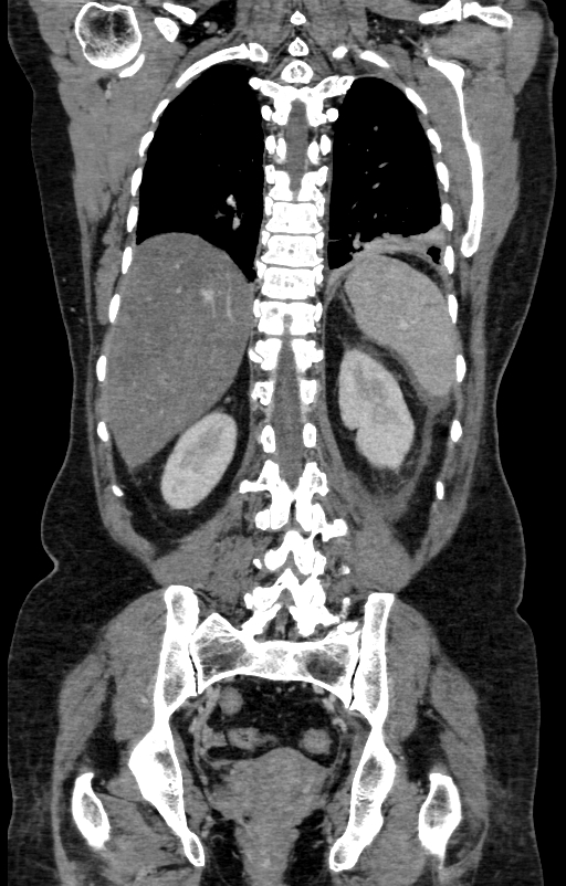 Acute pancreatitis (Radiopaedia 80007-93285 Coronal C+ portal venous phase 124).jpg