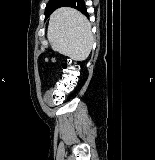 File:Acute pancreatitis (Radiopaedia 85390-101010 Sagittal C+ portal venous phase 9).jpg